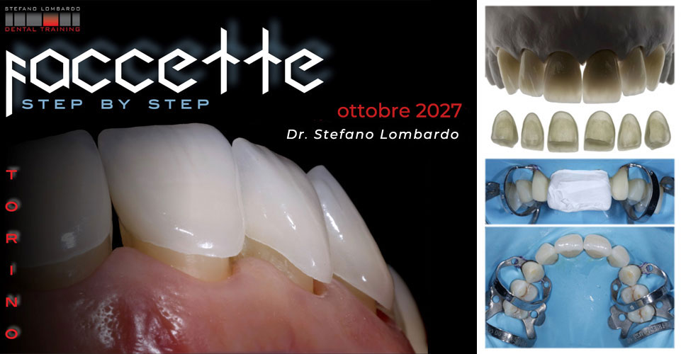 FACCETTE – Step by Step